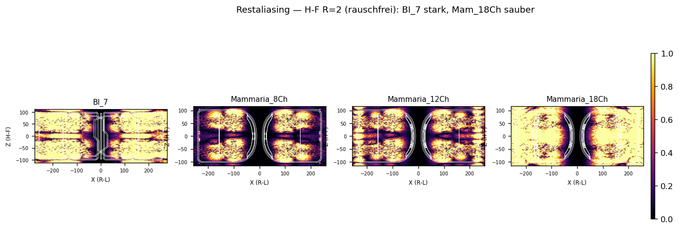 Restaliasing H-F R=2 rauschfrei